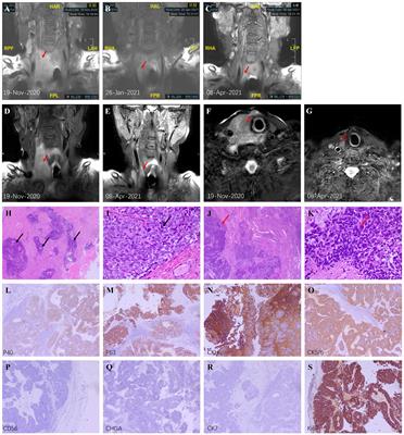 Anlotinib combined with Sintilimab is win-win cooperation for primary squamous cell carcinoma of the thyroid: A case report and literature review